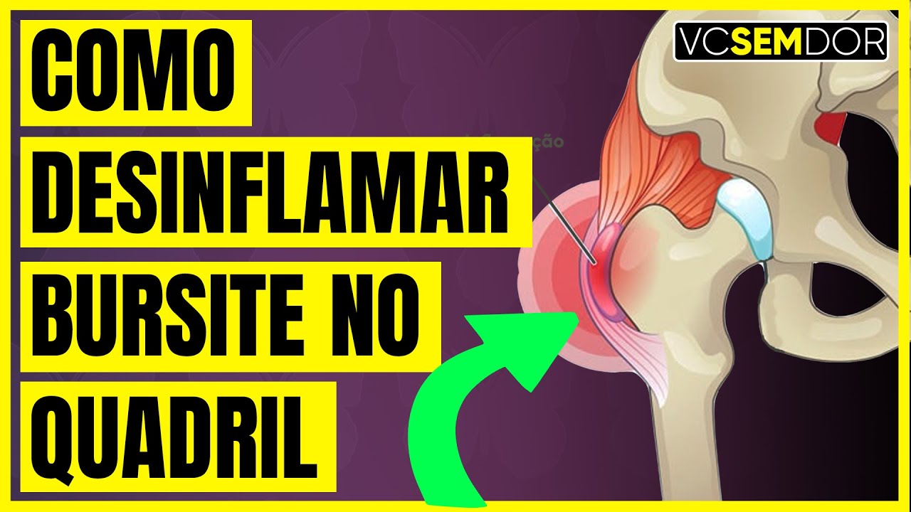 COMO DESINFLAMAR A SUA BURSITE NO QUADRIL