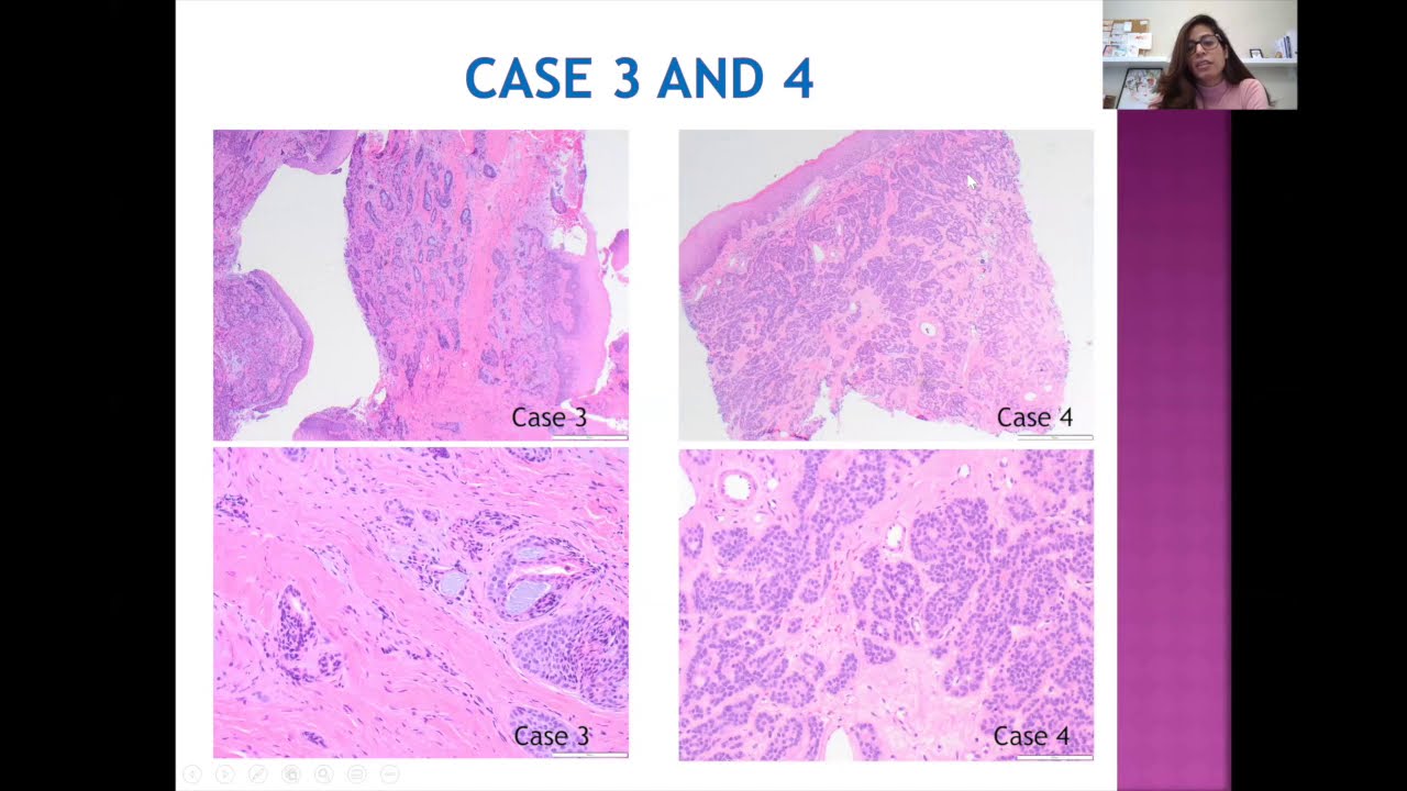 LG PathLab webinars - Salivary gland pathology