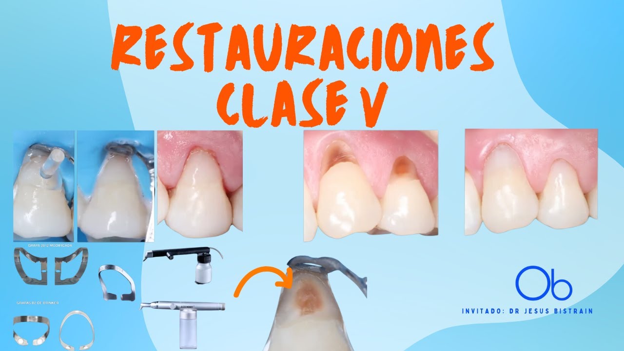 Restauraciones Clase V  🦷