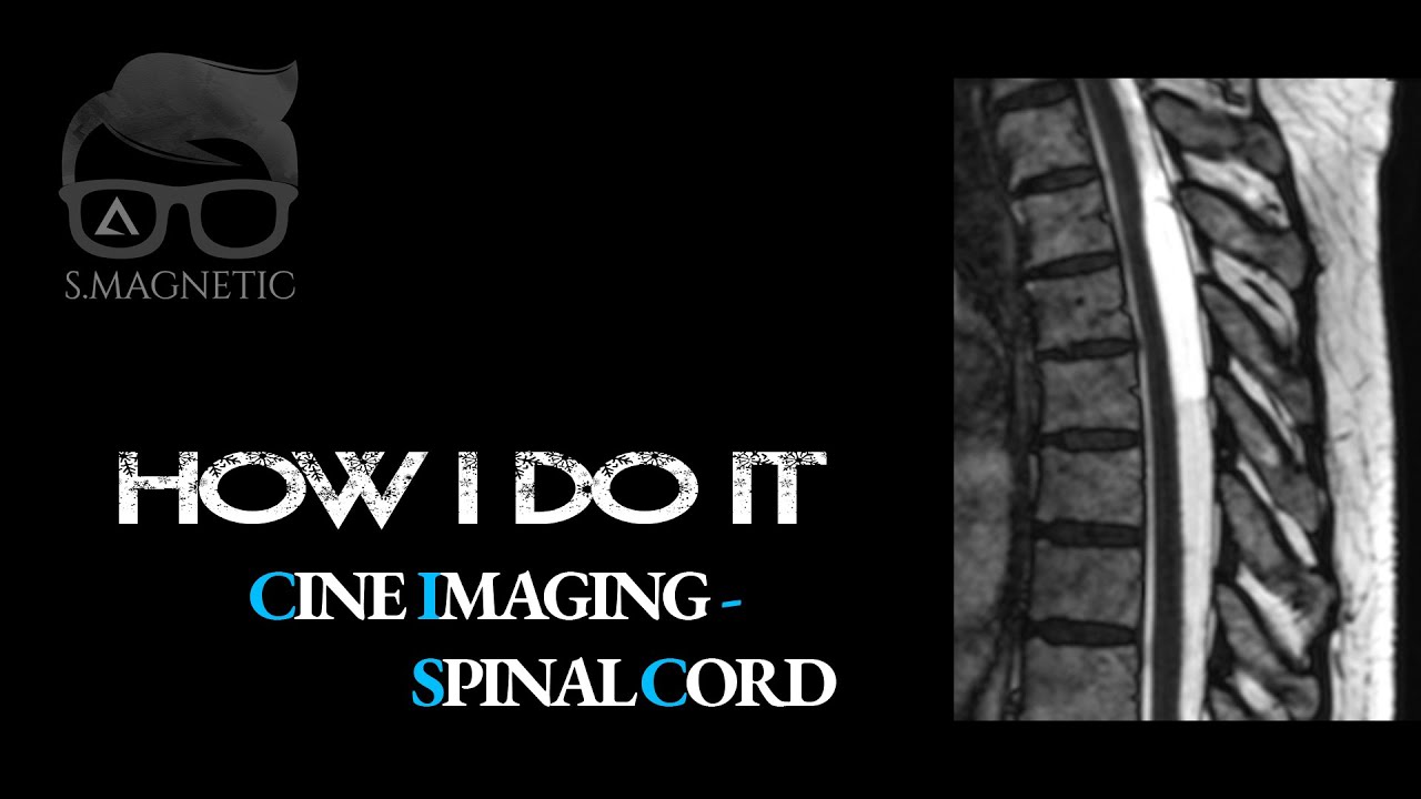 CINE IMAGING – SPINAL CORD (HOW I DO IT)