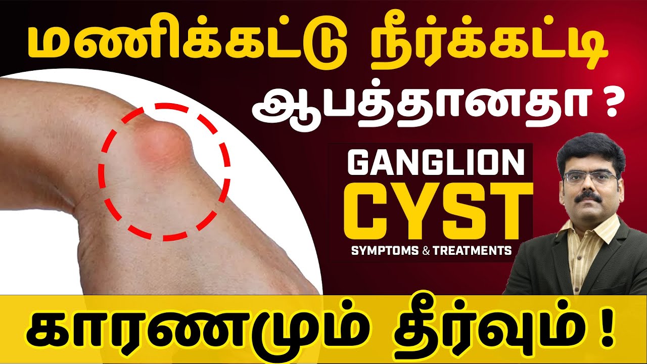 Ganglion Cyst Explained! Causes, Symptoms-Treatment in tamil -மணிக்கட்டில் கட்டி எளிய சிகிச்சை முறை