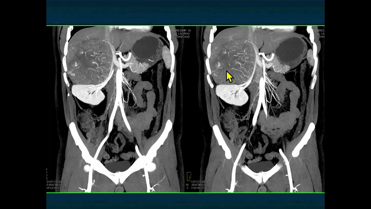 CT of the Large Adrenal Mass: Follow, Biopsy, Resect - Part 2