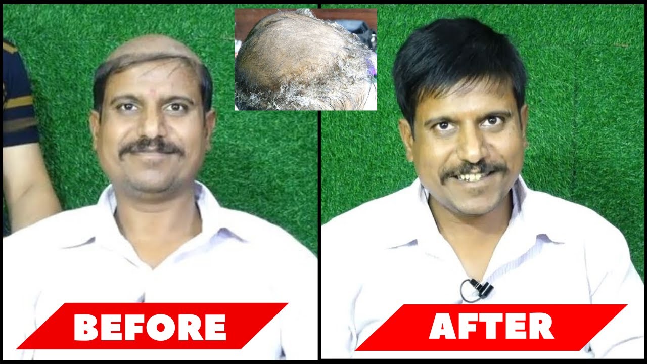 Hair patch Service for Men | Non Surgical Hair Replacement in @rkhairStudio