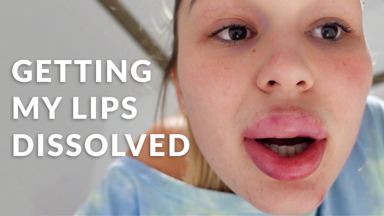 GETTING MY LIPS DISSOLVED - VLOG