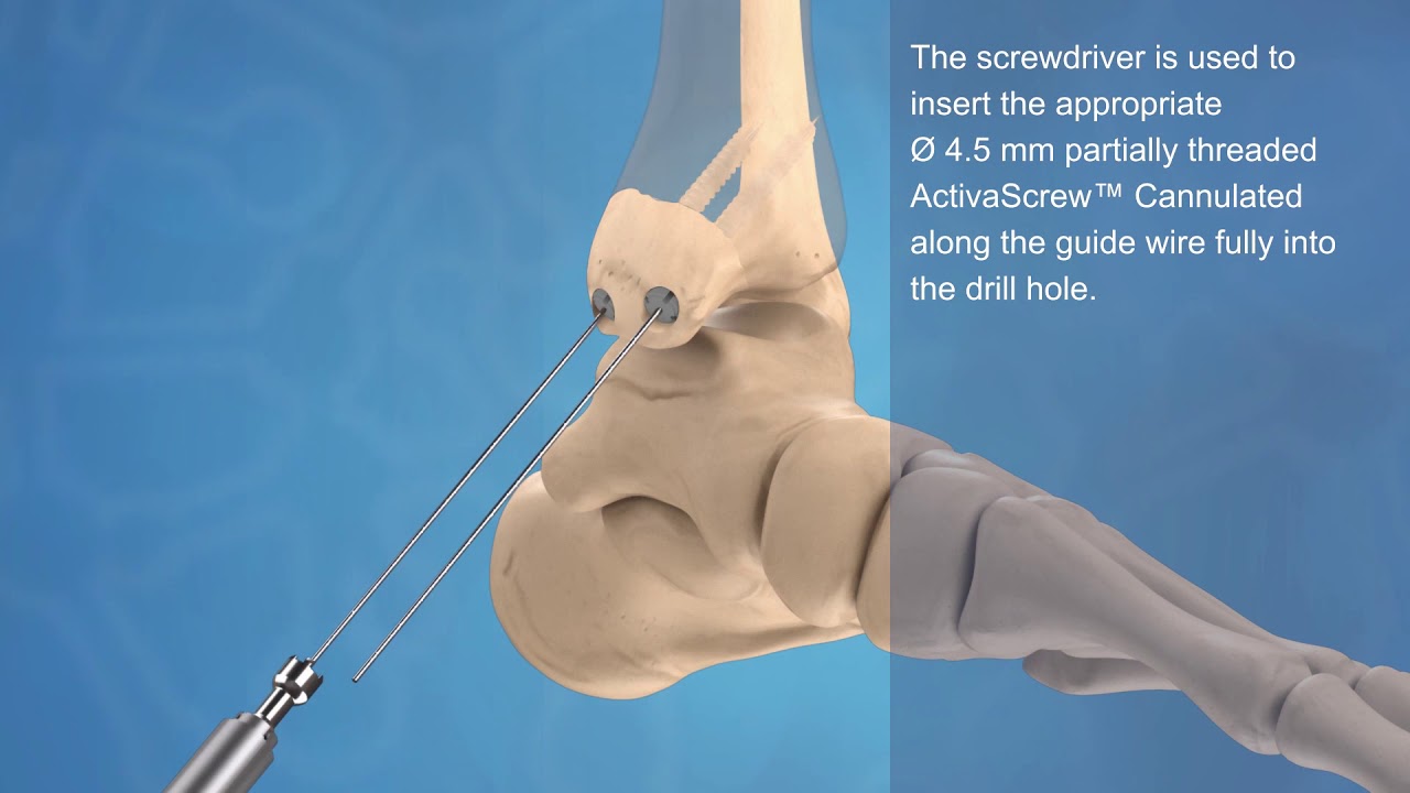 Malleolar and Syndesmosis Fracture Fixation with ActivaScrew™ Cannulated