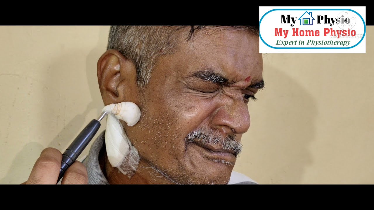 How to treat Bell's Palsy in 2022 Motor Stimulation Points, Physiotherapy for Bell's Palsy