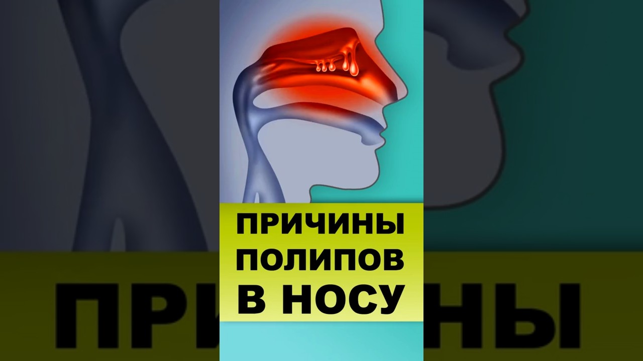 ПОЛИПЫ НОСА, причины, тактика лечения #полипыноса #полипы #ринит