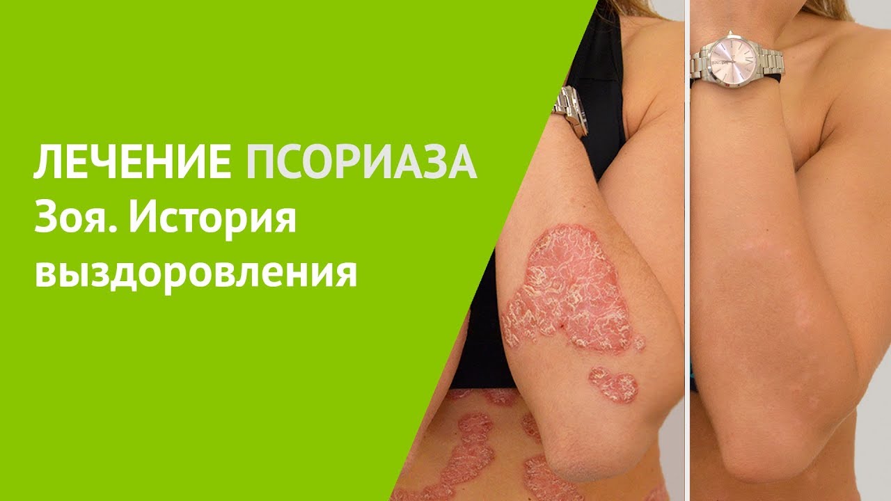 Лечение псориаза. Зоя, история выздоровления.