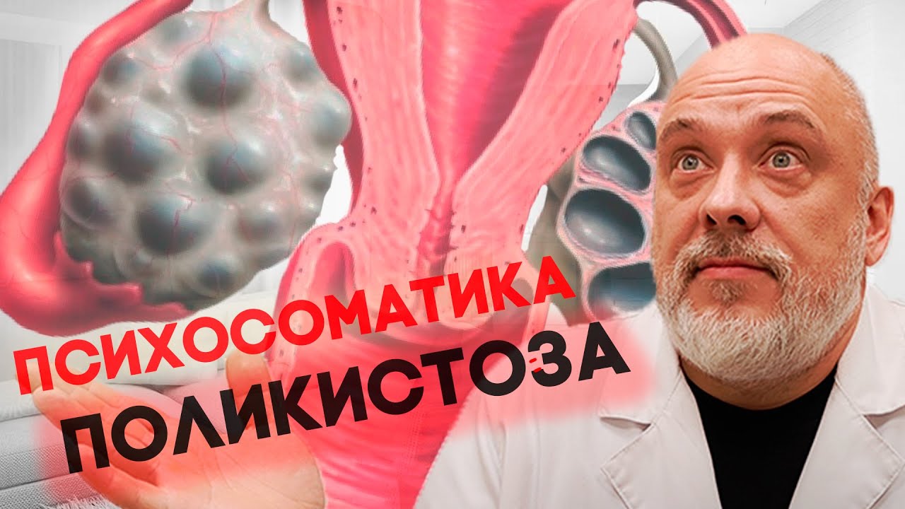 Полное РУКОВОДСТВО ПО ПОЛИКИСТОЗУ: что делать с точки зрения медицины и психосоматики