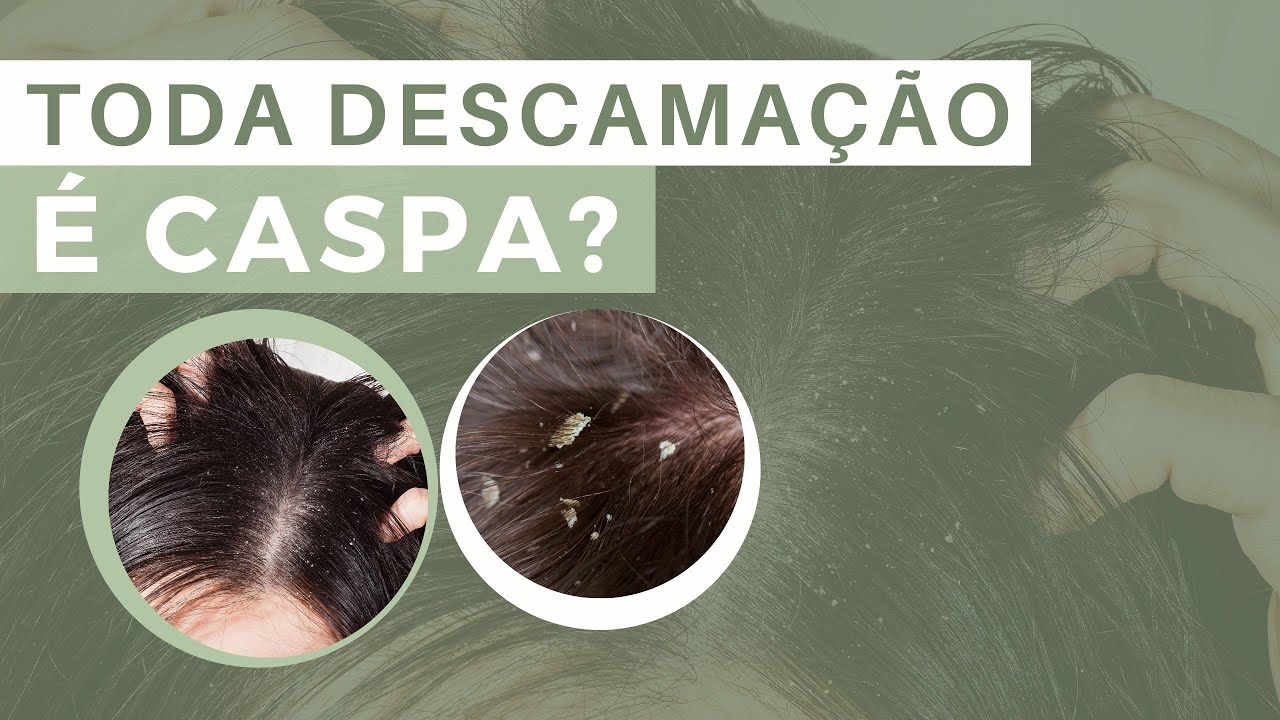 APRENDA A DIFERENCIAR DERMATITE SEBORREICA E CASPA | Dr. João Gabriel Fernandes