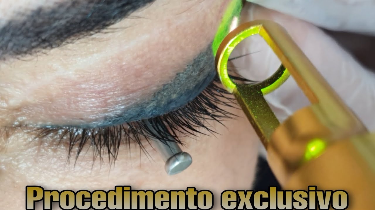 Remoção de delineado. Procedimento exclusivo!!! Despigmentação