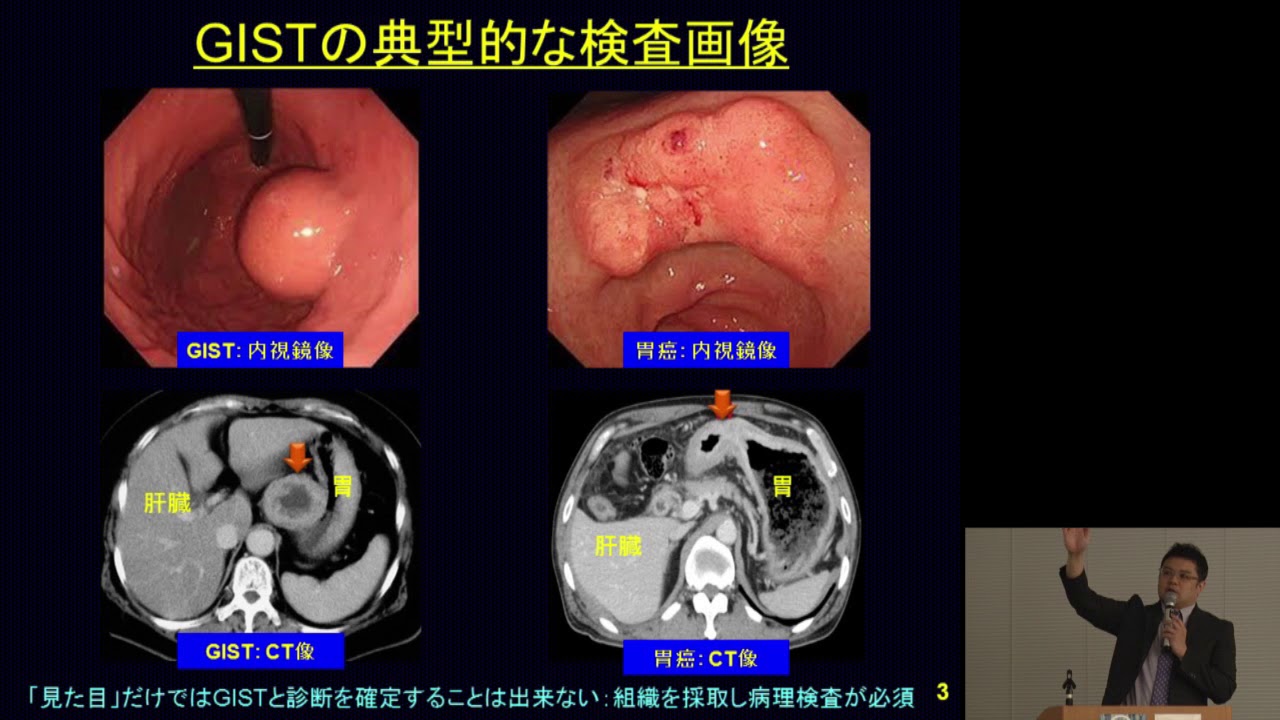 GISTの基礎知識　本間義崇【国立がん研究センター希少がんセンター】