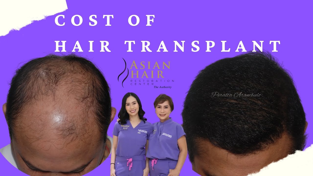 Cost  of Hair Transplant  | Asian Hair Restoration Center