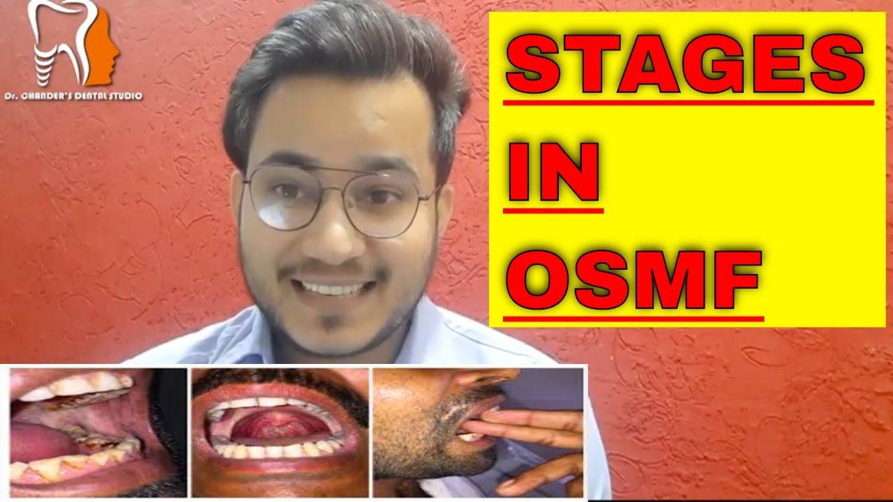 STAGES IN OSMF IN HINDI EARLY AND ADVANCED STAGES- ORAL SUBMUCOUS FIBROSIS STAGES| DR.CHANDER UDHEY