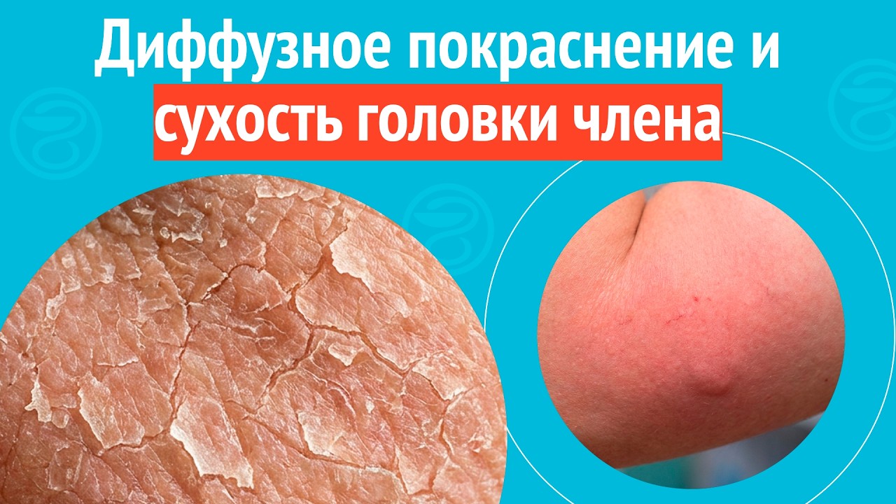 😡 Диффузное покраснение и сухость головки члена. Клинический случай № 1744