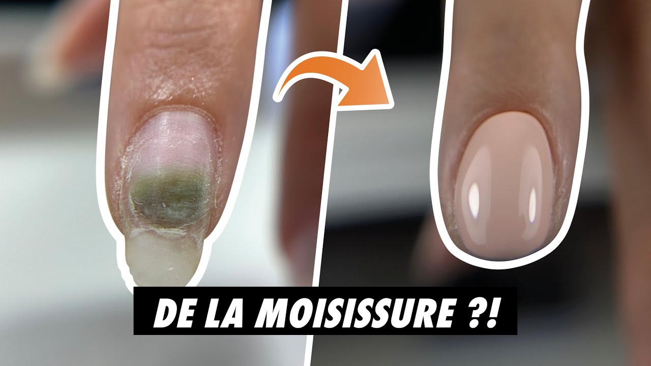 Un ONGLE MOISSI ? 🤢 Ou comment GÉRER une INFILTRATION 🧐