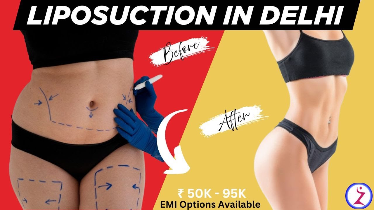 Liposuction In Delhi | Liposuction Before And After | Liposuction Recovery - Zenith Clinic