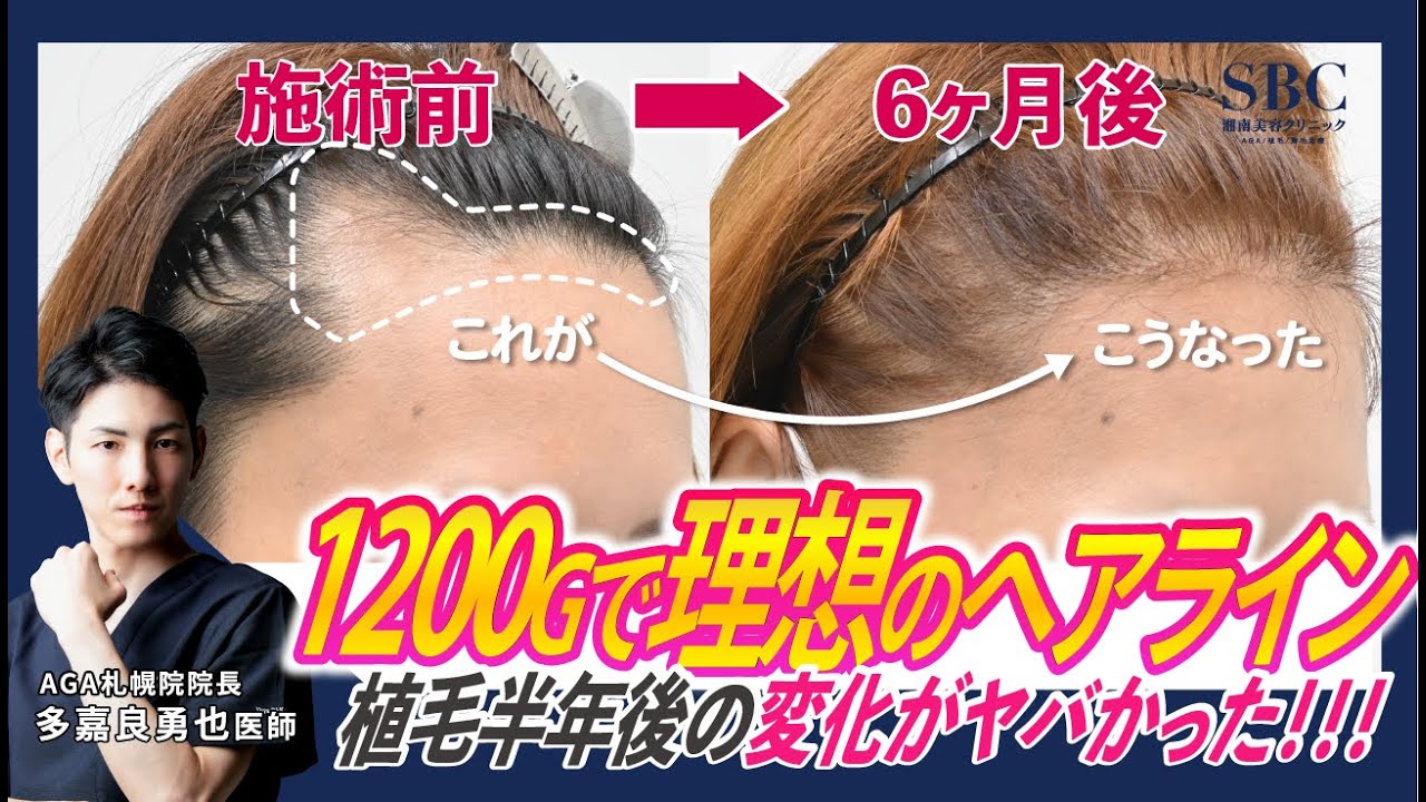 【40代女性の自毛植毛】理想のヘアラインにたった半年で！？