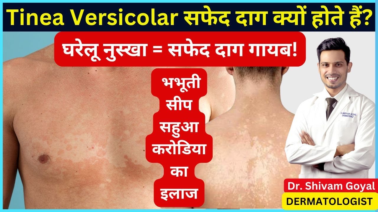 Tinea Versicolor का इलाज | सफेद दाग (सीप/भभूती/सहुआ) का पक्का इलाज | Fungal Infection Treatment