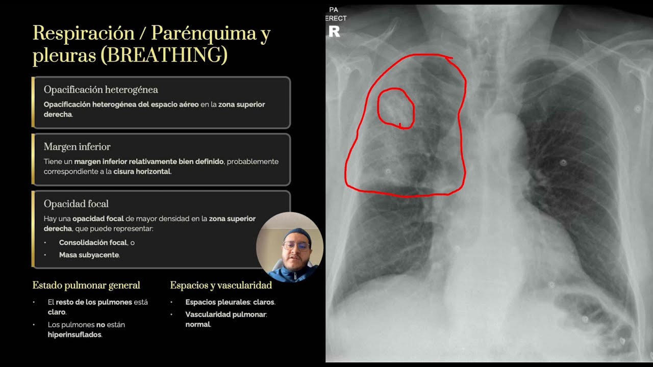 Radiografía de tórax: lectura sistemática PASO A PASO (caso clínico + solución)