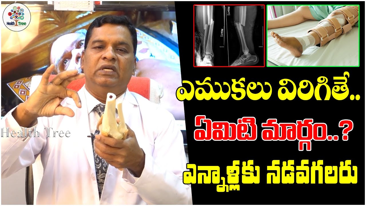 ఎముకలు విరిగితే.. ఏమిటి మార్గం..?| Bone Fracture - Healing Time | Dr. Vijay Bhaskar | Health Tree