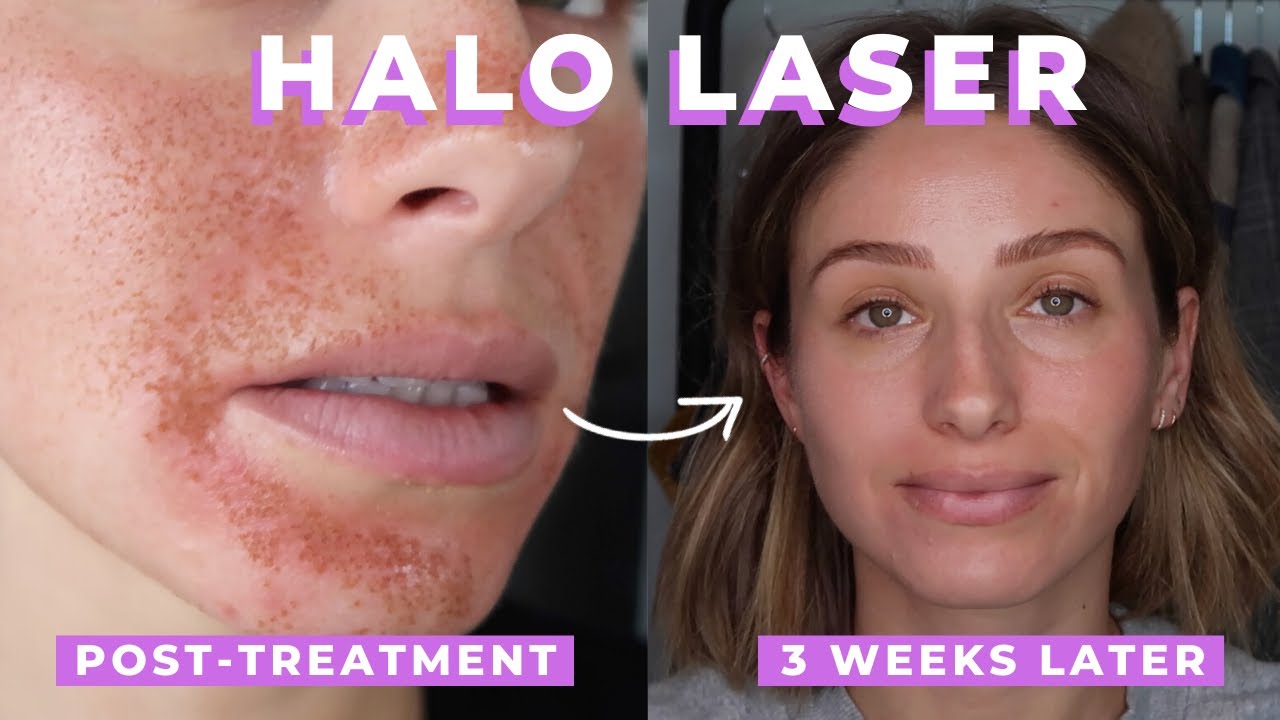 HALO LASER TREATMENT REVIEW | SKIN LASER