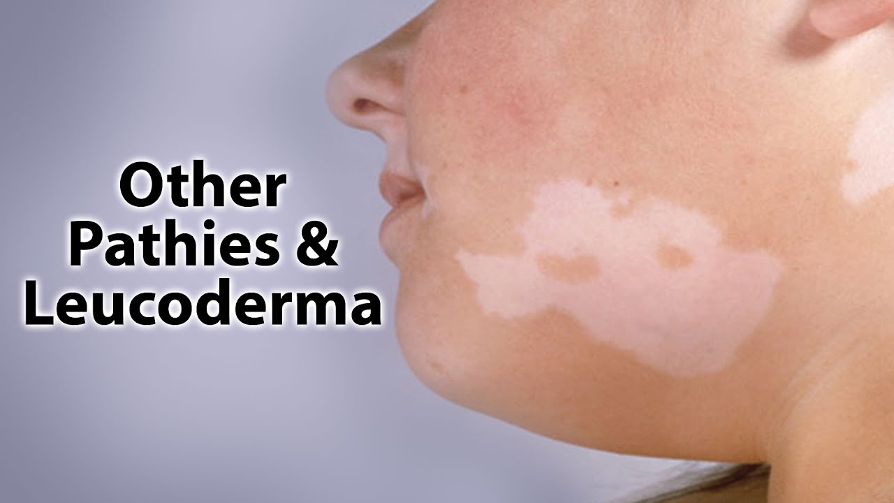 Other Pathies & White Patches/Leucoderma