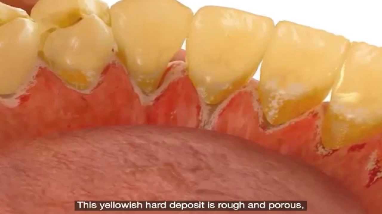 Common Dental Problems: Tartar (Calculus)