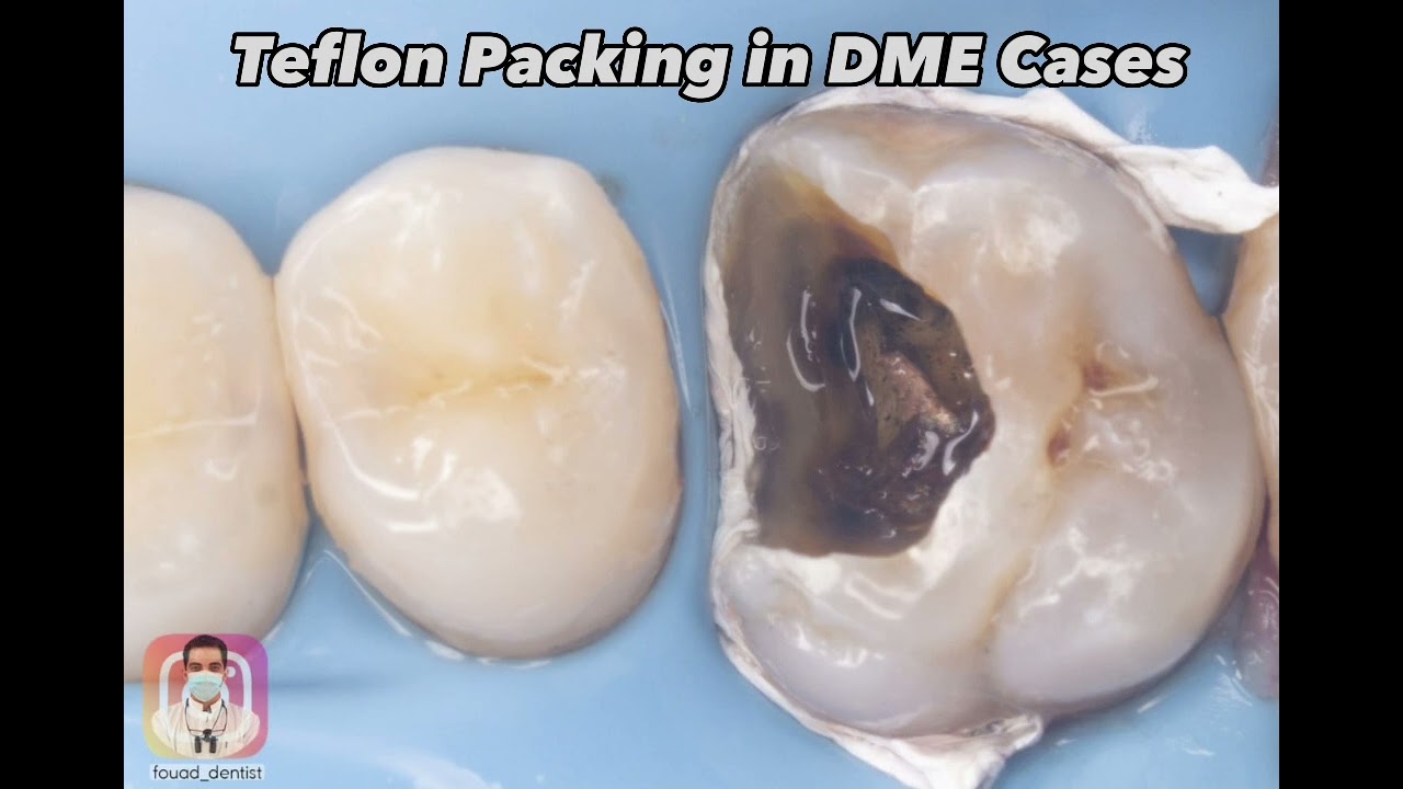 4 Tips and Tricks Teflon Packing  In DME Cases