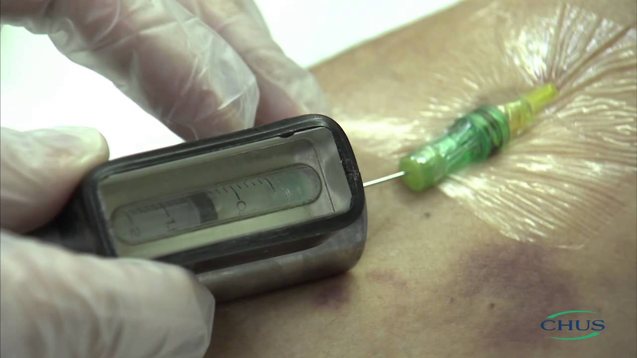 Позитронно-эмиссионная томография | ПЭТ