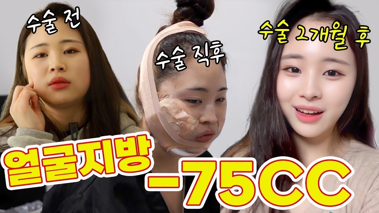 얼굴에 있는 지방 다 빼고왔어요 :) | 이중턱 + 심부볼 지방흡입 | 디마레TV