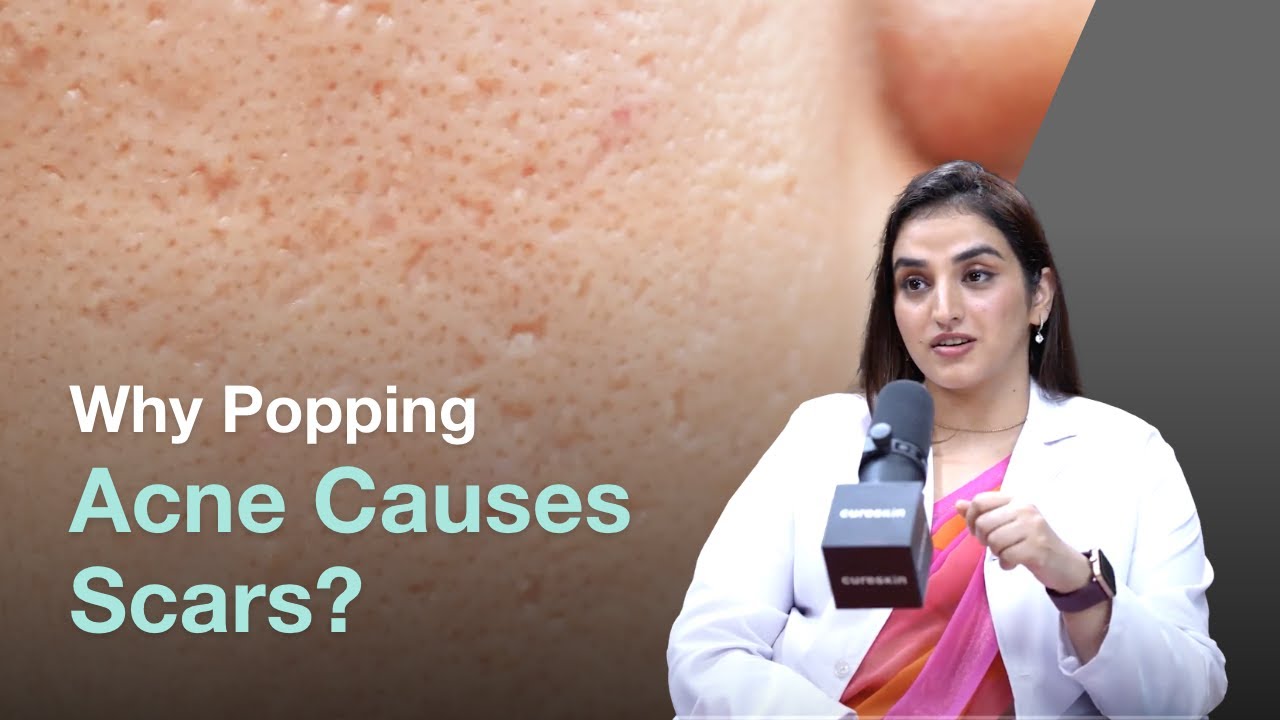 How Can Popping Pimples Leads to Acne Scars?