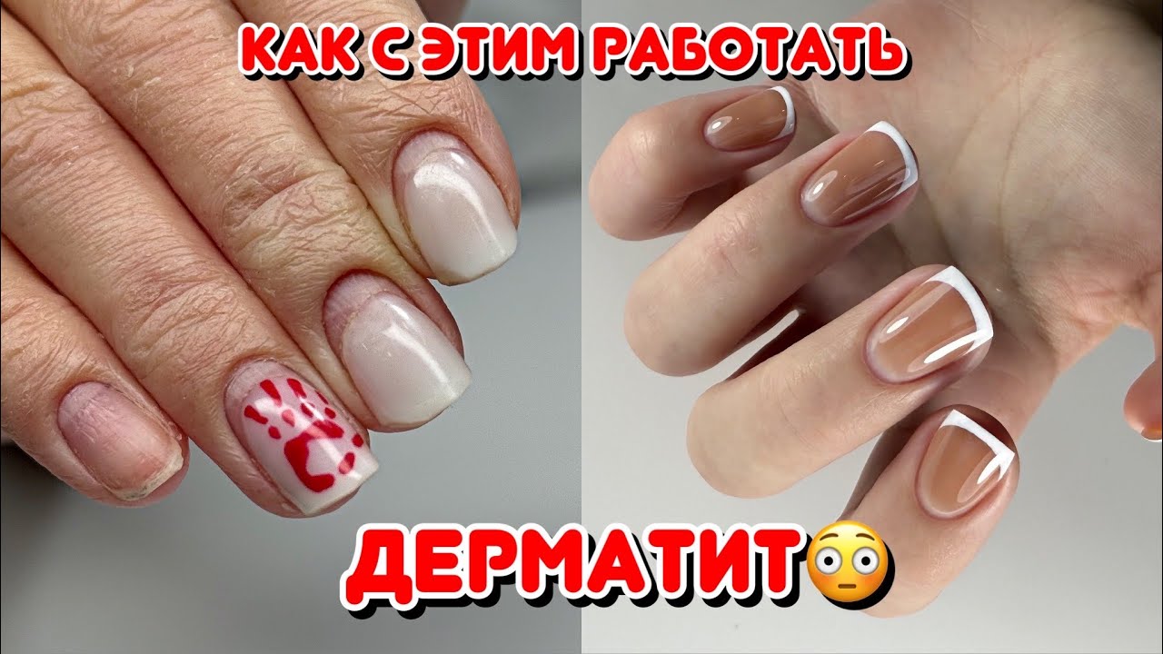 ДЕРМАТИТ у подростка‼️ КАК с этим работать⁉️ маникюр на сложных руках