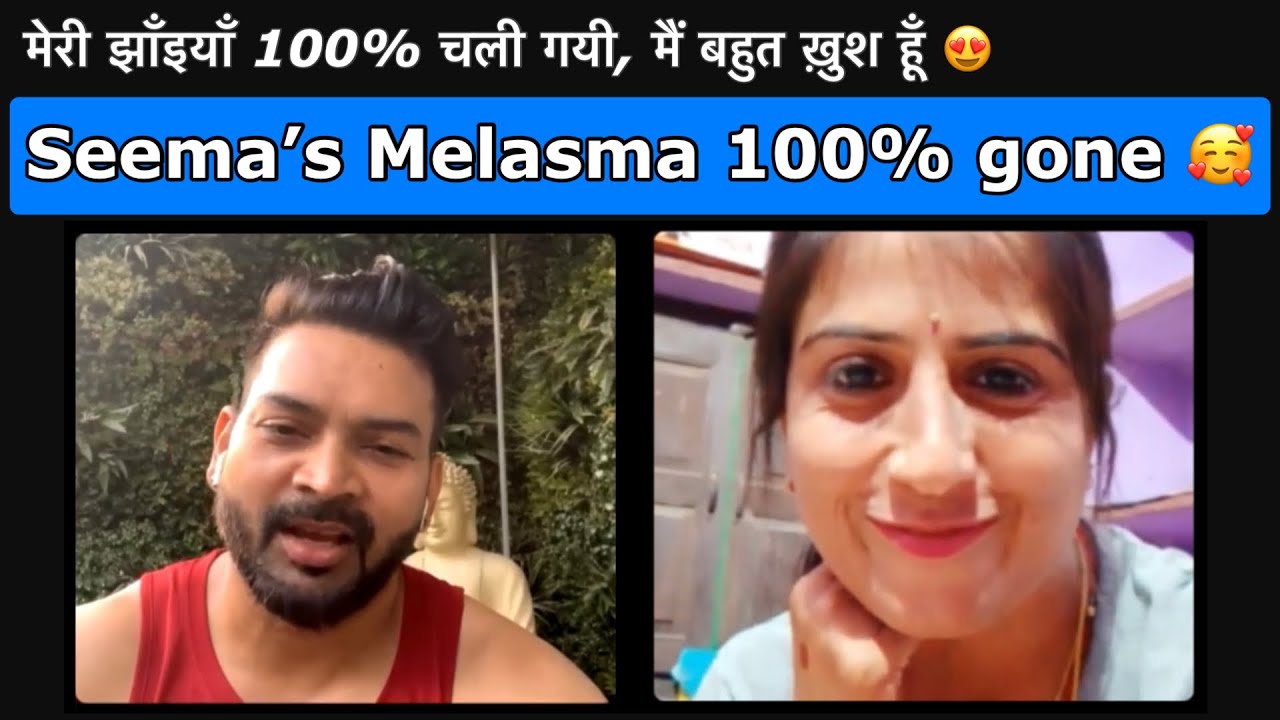 Seema’s Melasma gone 100%. मेरी झाँइयाँ 100% चली गयी, मैं बहुत ख़ुश हूँ 😍