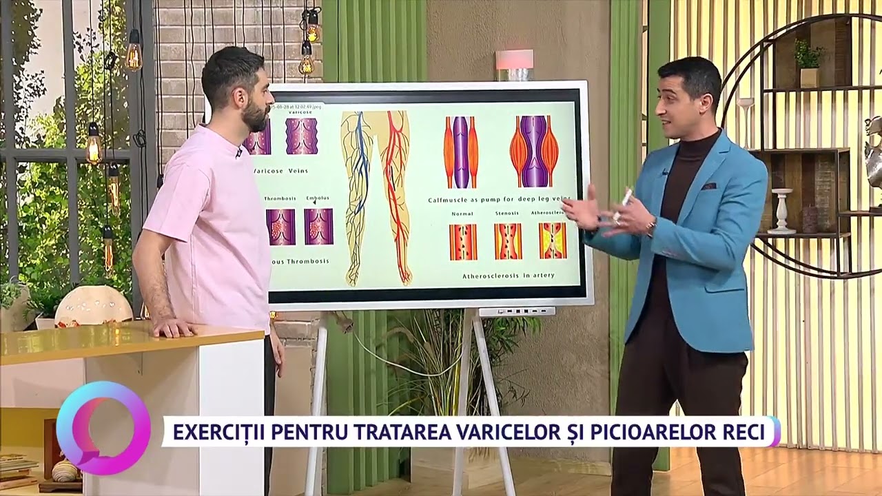 Exerciții pentru tratarea varicelor și picioarelor reci