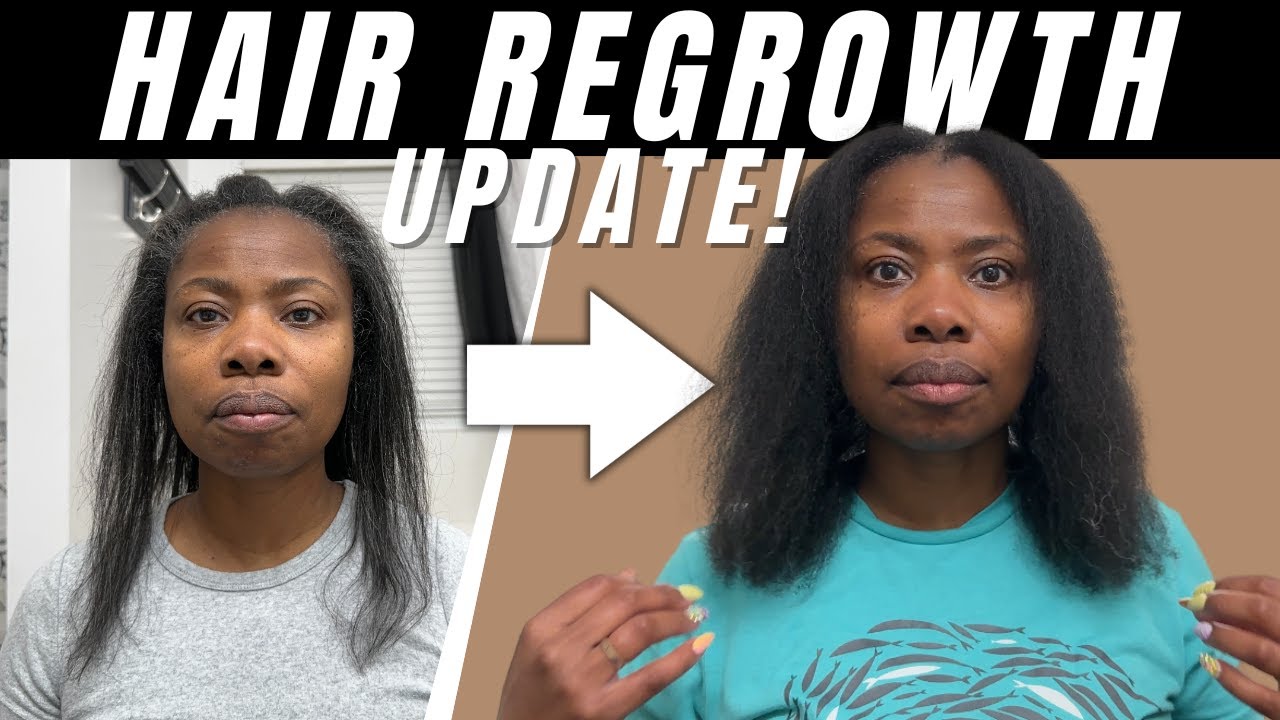 From Shedding to Strength: My Hair Regrowth Testimony | Hair Loss Update