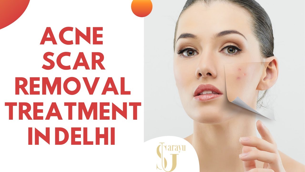 Acne Scar Removal in Delhi | Laser Acne Scar Removal | Acne Scar removal Treatment in Delhi #shorts