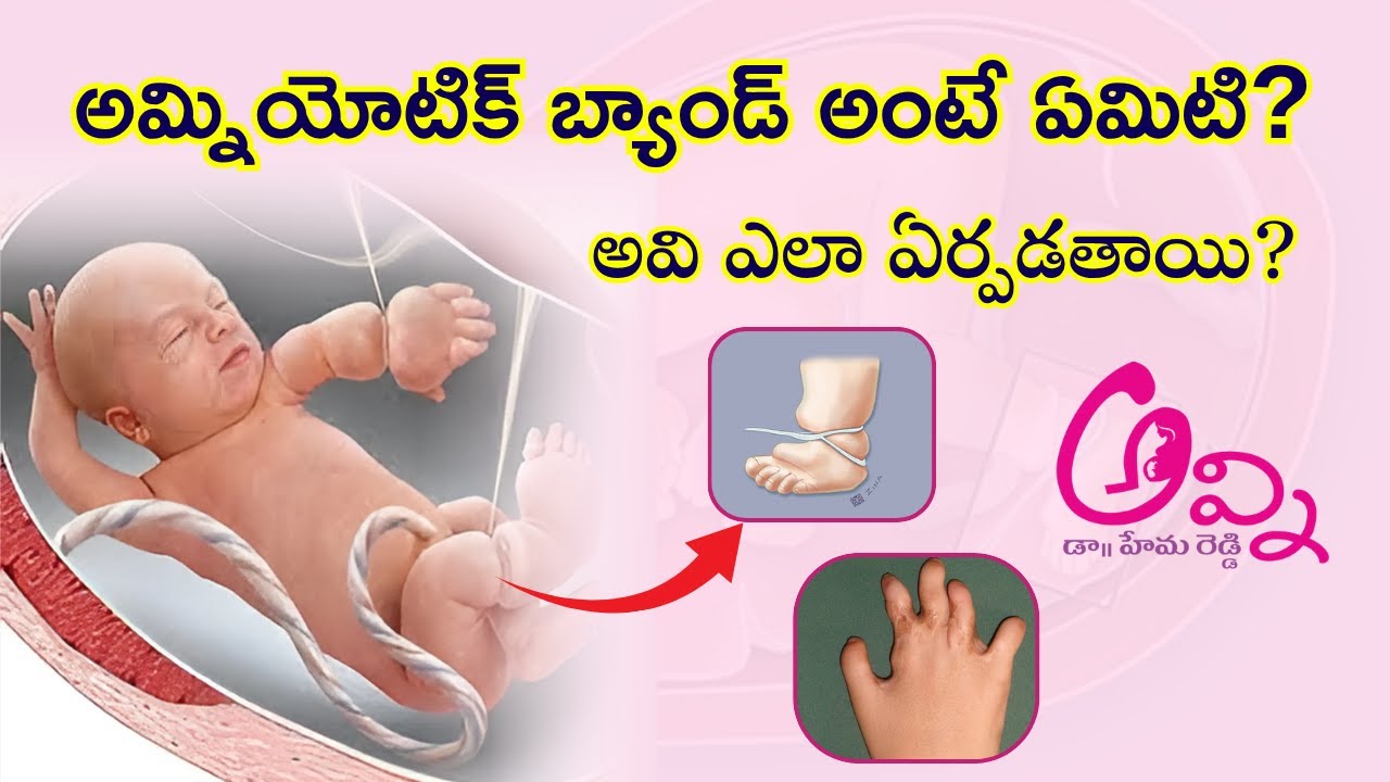 అమ్నియోటిక్ బ్యాండ్ అంటే ఏమిటి? | Dr. Hema Reddy | Senior Gynecologist| Avni Women's Hospital