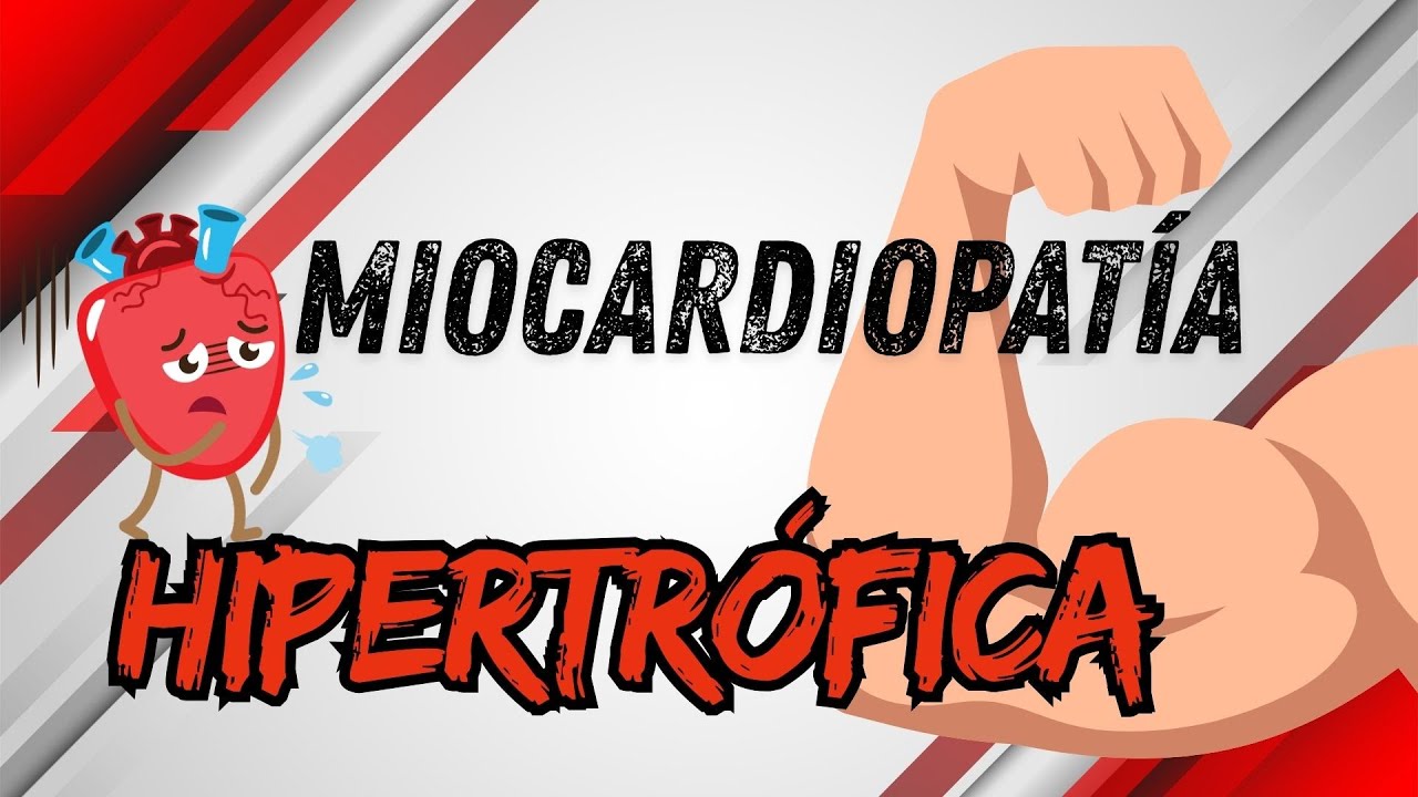 CARDIOMIOPATÍA HIPERTRÓFICA