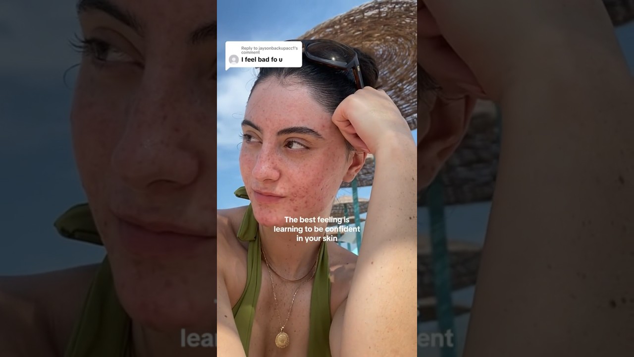 Feeling bad over how your skin looks? #acnepositivity #beautytips #skinpositivity #confidence
