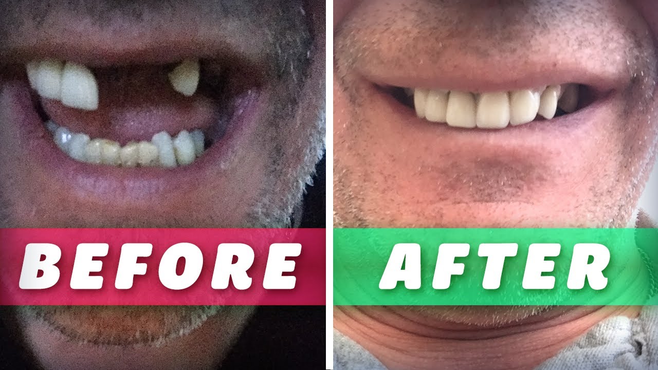 How to Make Home Made False Teeth | Do It Yourself Dentures | Fix a Missing Tooth | FULL TUTORIAL