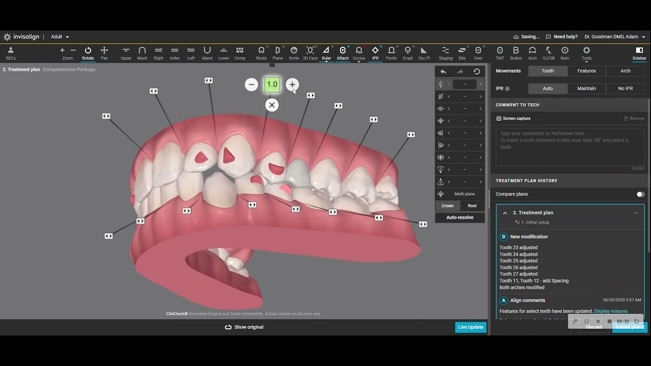 Clincheck for a Moderate Invisalign Case That is Doomed to Fail