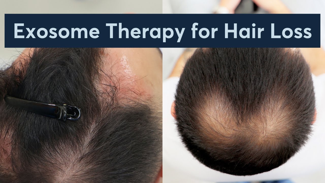 Why Are People Turning to Exosome Therapy for Hair Loss?