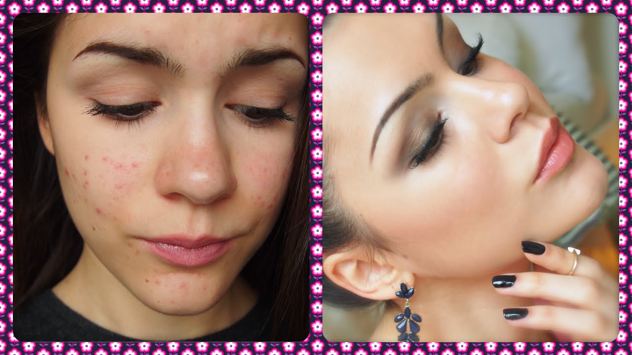 ⭐️ Acne Update! 2 Months After Doxycycline Therapy! ⭐️