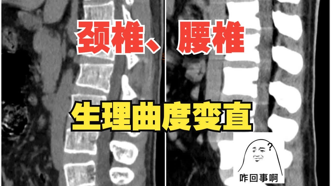 脊柱生理曲度：颈椎变直反弓？腰椎生理曲度变直？咋办？
