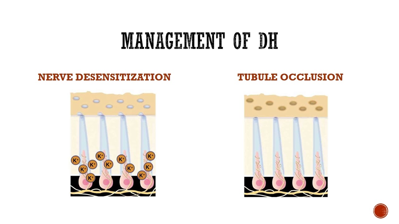 Dentinal Hypersensitivity