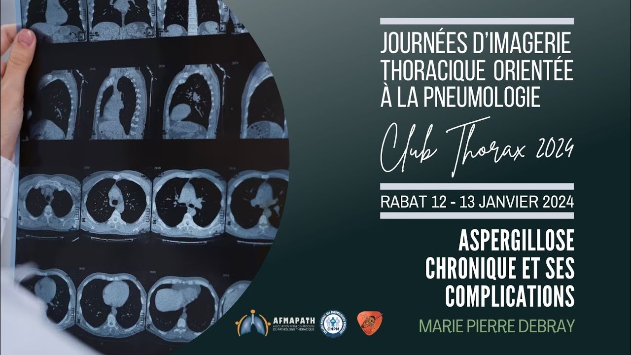Aspergillose chronique et ses complications. Marie Pierre Debray