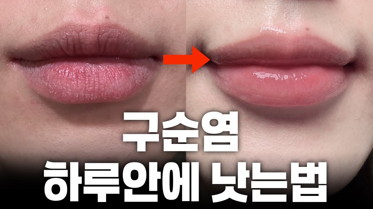 구순염 빨리 낫는법ㅣ구순염에 효과 있었던 찐템ㅣ내돈내산 건조하고 따가운 입술 보습 립밤 추천