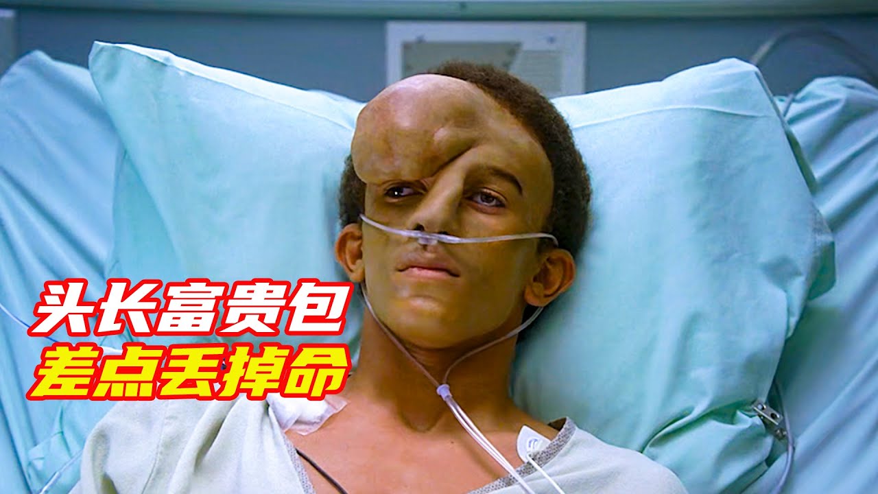 男孩頭上長個富貴包，引起整個社會的關注，險些要命；獵奇，怪病，豪斯醫生，電影解説合集