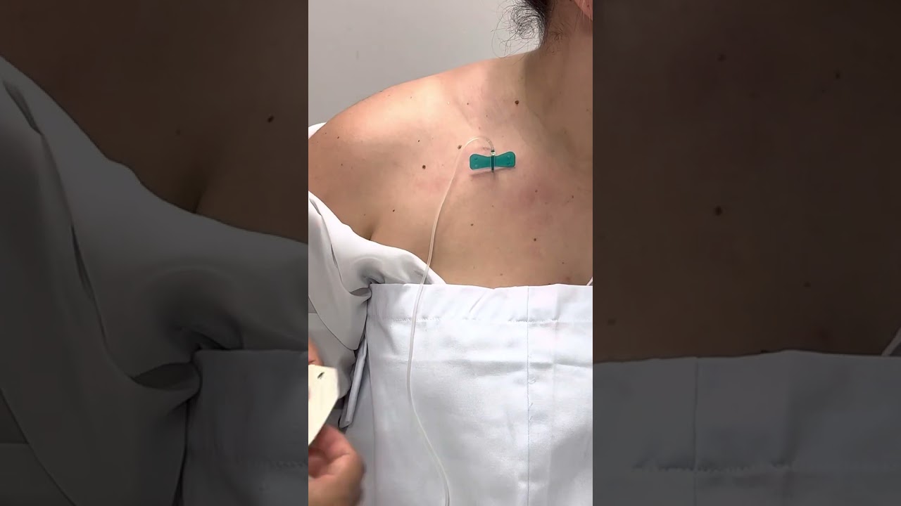 Colocación de bomba de infusión subcutánea